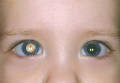 Как диагностировать катаракту у новорожденного?