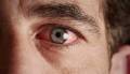 Инфицирование органов зрения микоплазмозом
