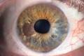 Онкология глаза. Диагностика и лечение