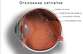Отслоение сетчатки: яркие вспышки, как предвестники темноты