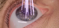 Лазерное лечение глаз: назначения, преимущества, недостатки