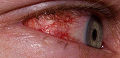 Хламидийная инфекция глаз. Причины и лечение