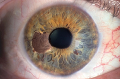 Пигментная глаукома. Причины и следствия.