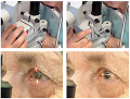 Реабилитация пожилых людей после лазерной коррекции зрения