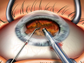 Американцы объяснили, почему количество операций по удалению катаракты снижается
