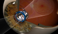 Телескопическая контактно-линзовая система для больных ВМД