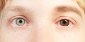 Опасность операций модифицирующих внешний вид глаз