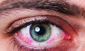 Синдрома сухого глаза, как проблемы иммунитета