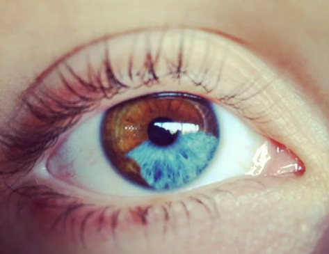 Разный цвет глаз у одного человека это болезнь