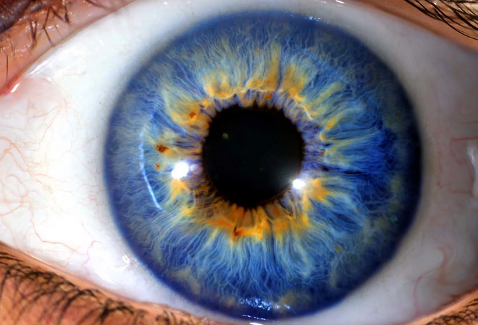 Как называется болезнь когда два глаза разного цвета
