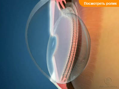 Хрусталик