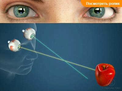Косоглазие (Гетеротропия). Симптомы.