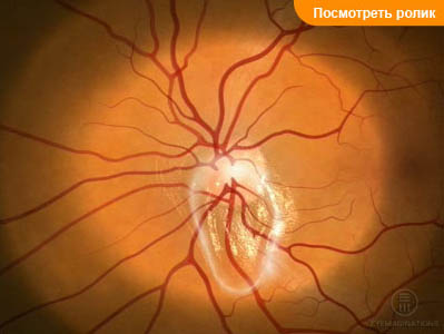 Циклоплегия