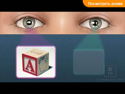 Амблиопия.