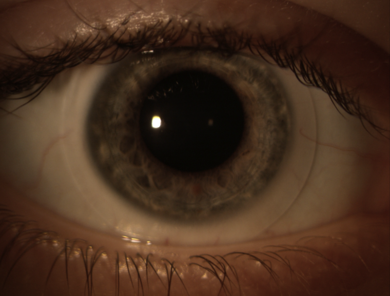 Сколько восстанавливается зрение после лазерной. Глаза после лазерной коррекции зрения. Глаза после лазерной коррекции. Линза для лазерной коррекции зрения. Глаза после коррекции щиения.